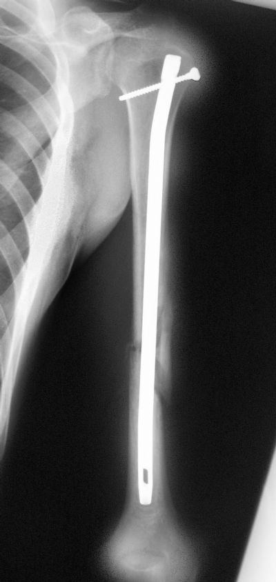 Sta+Peg+Implant AP: Smith+Nephew humeral nail for comminuted shaft fracture. Lock ...