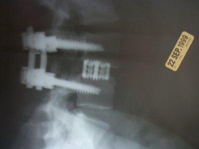 Spine-Tech BAK Cage (Implant 46)