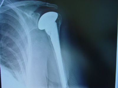 Tornier Hemiarthroplasty Shoulder Prosthesis (Implant 193)