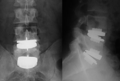 Spine: Lumbar, Artificial Discs:  Synthes ProDisc (Implant 386)