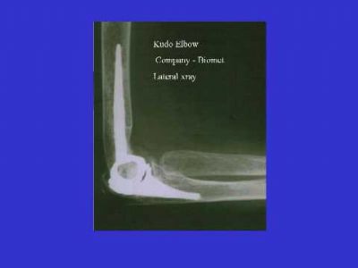 Kudo Total Elbow Prosthesis (Implant 151)