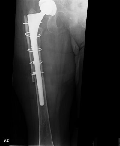 Hip Prostheses:  Total, Revision, Biomet Reach (Implant 427)