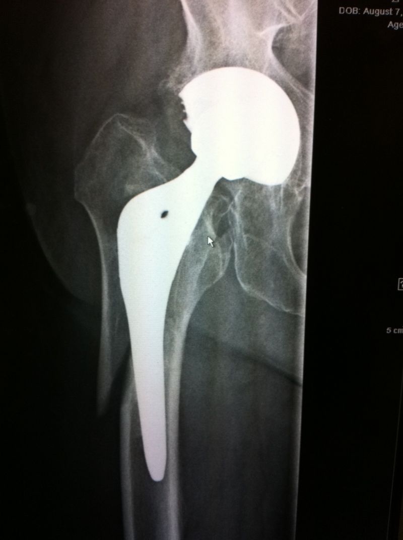 Hip Prostheses: Total, Primary: Unidentified (Implant 4271 ...