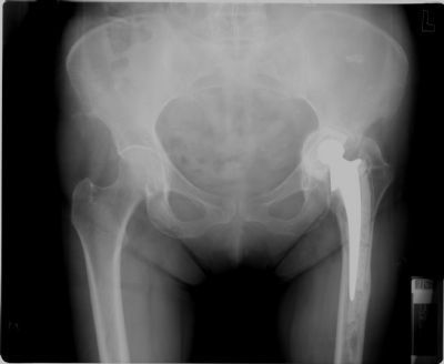 Hip Prosthesis, Total, AP:  Unidentified (Implant 4176)