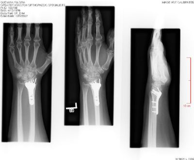 Radius, Distal:  Tornier CoverLoc (Implant 2062)