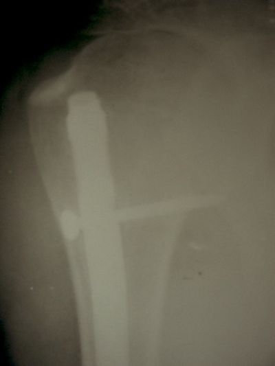 Humerus, Nail, AP:  Unidentified (Implant 707)