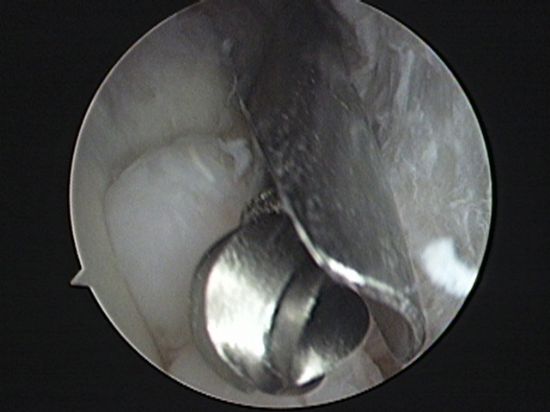 Video:  Elbow Arthroscopy:  Avoiding Complications featuring Bernard F. Morrey, MD