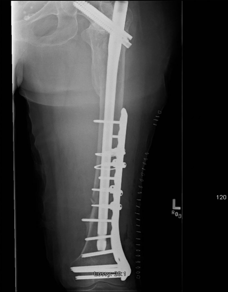 PDF] Comparison of retrograde intramedullary nailing and bridge plating in  the treatment of extra-articular fractures of the distal femur. | Semantic  Scholar