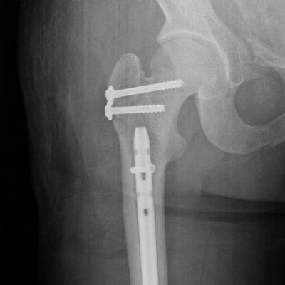 Using humeral nail for surgical reconstruction of femur in adolescents with  osteogenesis imperfecta