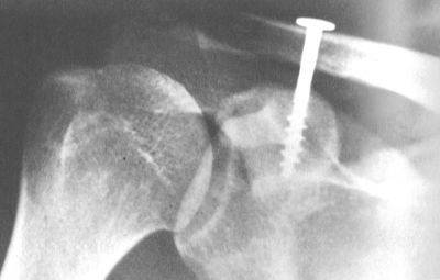 Bosworth Screw (Implant 430)