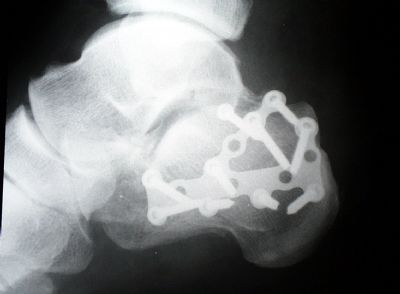 Synthes Calcaneous Plate (Implant 236)