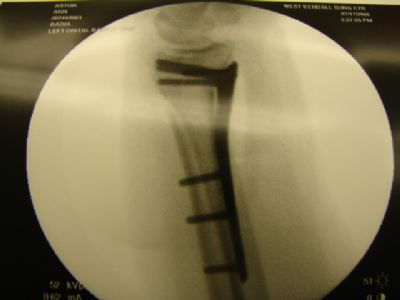 Radius, Distal:  Medartis Volar Plate (Implant 424)