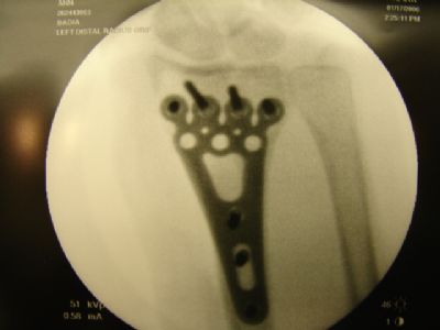 Radius, Distal:  Medartis Volar Plate (Implant 425)
