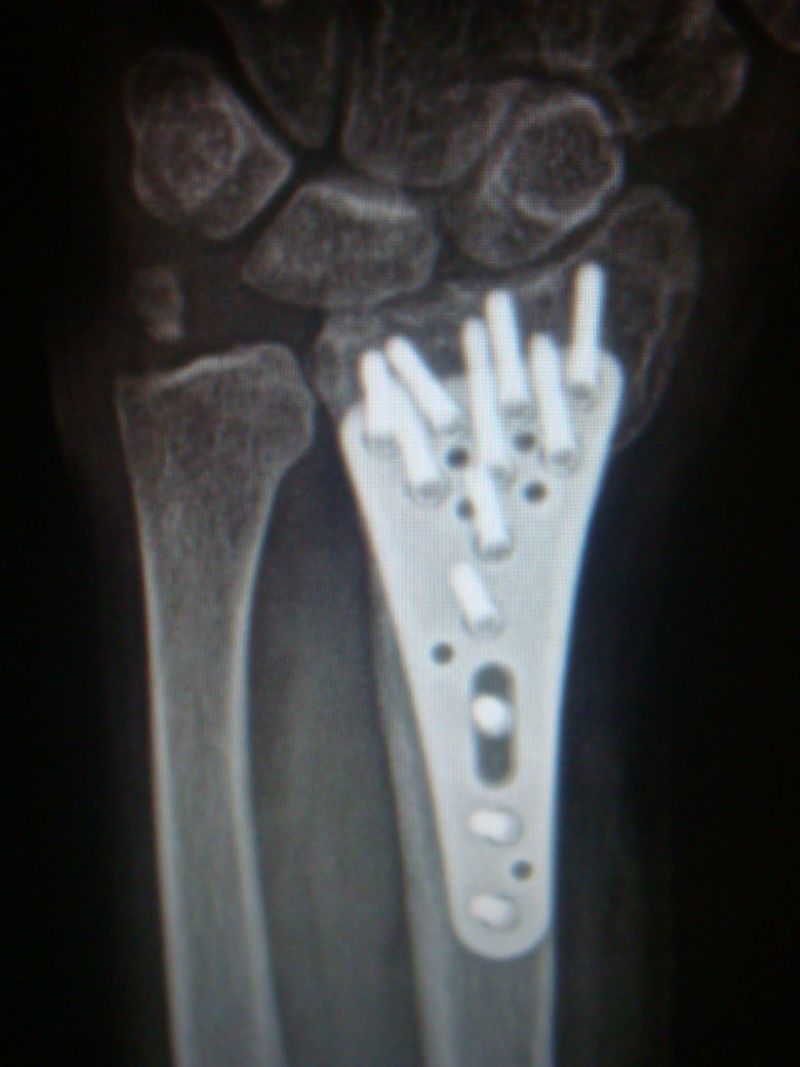 Radius, Distal:  Medartis Osteotomy Plate (Implant 4239)