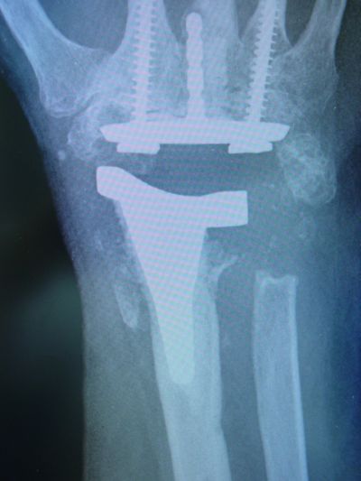 Wrist Prostheses:  KMI (Implant 194)