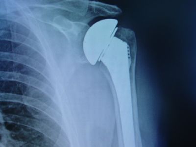 Arthrex Hemiarthroplasty Shoulder Prosthesis (Implant 192)