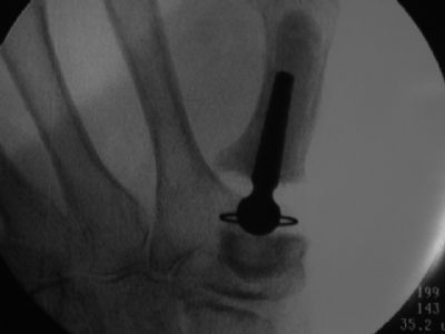 Braun-Cutter Thumb TJA (Implant 333)