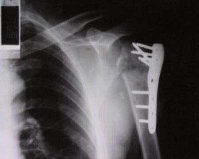 PLACA SPIN Proximal Humerus Plate (Implant 843)