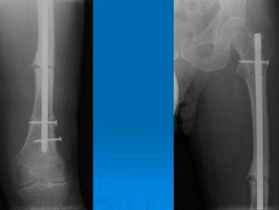 Stryker Trauma  Extremities  Femoral Nailing  T2 Recon  YouTube