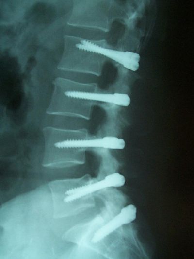 Zimmer Dynesys (Implant 384)