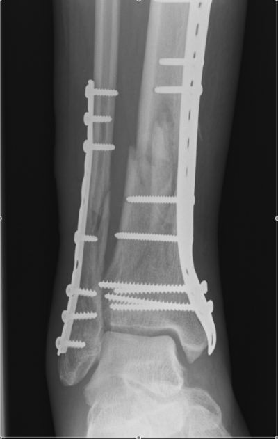 Stryker Precontoured Tibial Plate (Implant 634)