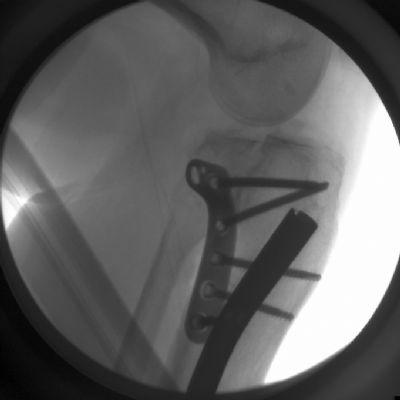 EBI Precontoured Tibial Plateau Plate (Implant 638)