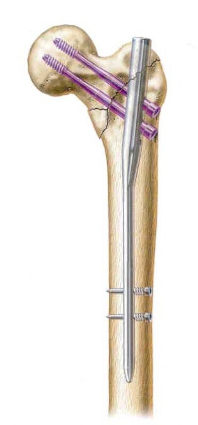 Plain radiograph showing AO 31-A3.3 intertrochanteric femur fracture... |  Download Scientific Diagram