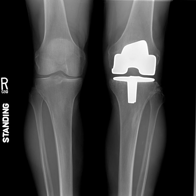 Biomet AGC Total Knee Prosthesis (Implant 4245)