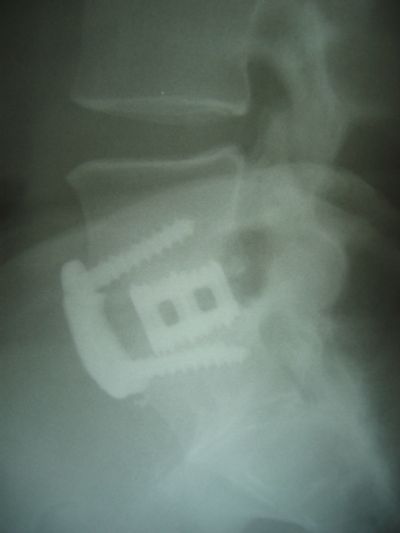 Spine-Tech and Sofamor-Danek (Implant 51)