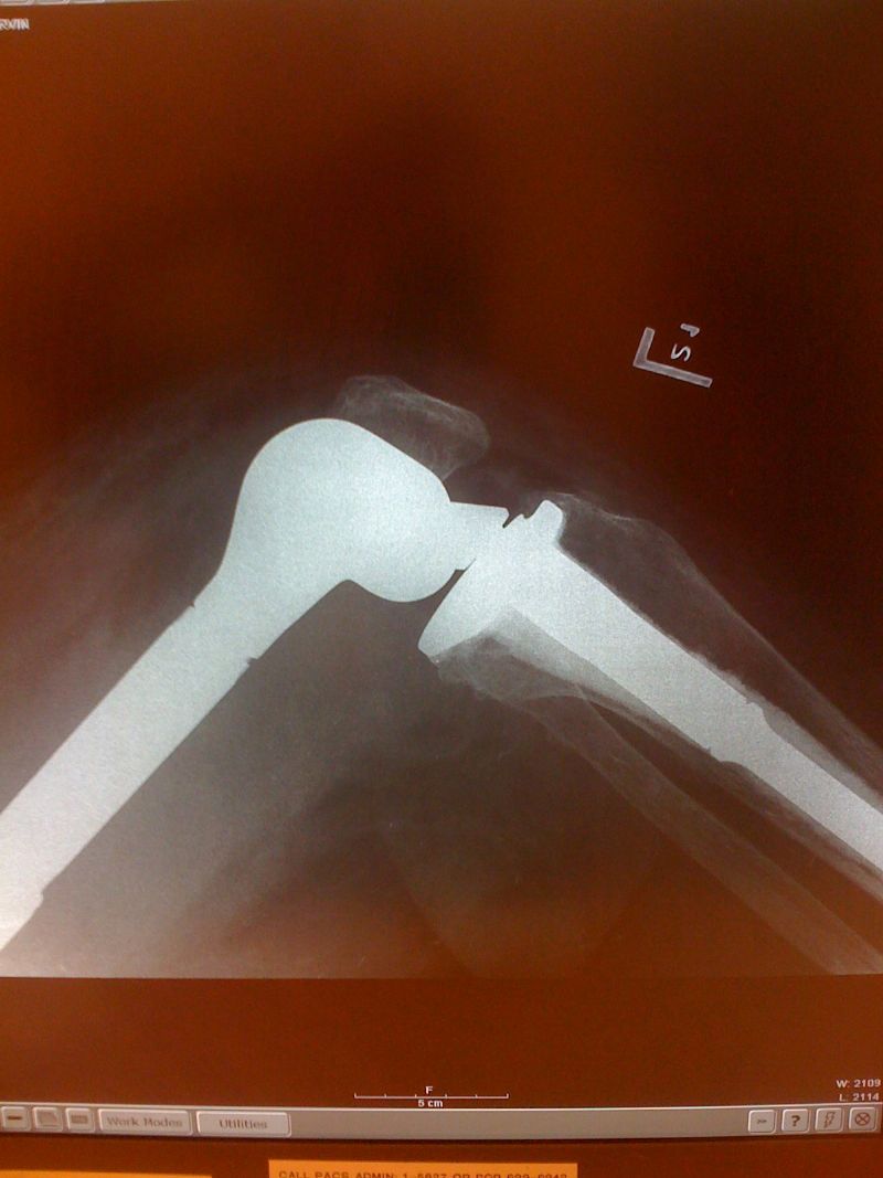 Implant Identification