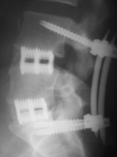 BP Cages and Sextant Screws (Implant 47)