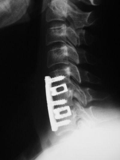 Spine, Cervical:  Synthes Syncage and ACS Plate (Implant 394)