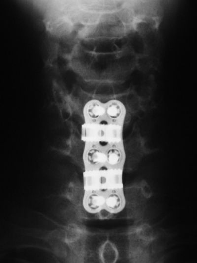 Spine, Cervical:  Synthes Syncage and ACS Plate (Implant 395)