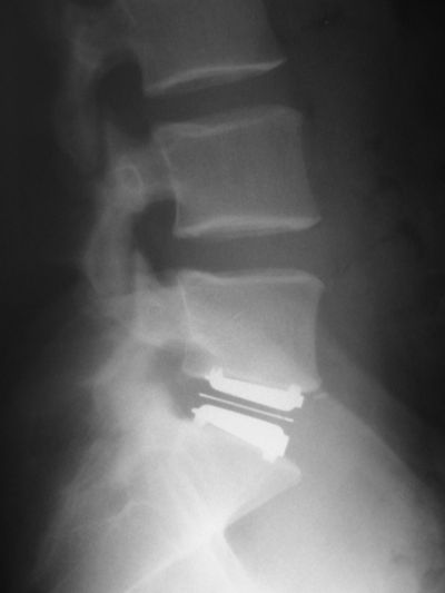 Spine: Lumbar, Artificial Discs:  DePuy Charite (Implant 390)