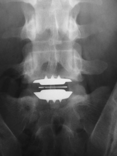 Spine:Lumbar, Artificial Discs:  DePuy Charite (Implant 391)