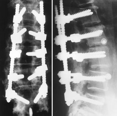 Edwards Modular System (Implant 385)