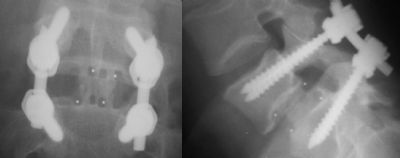 DePuy Brantigan (Implant 50)