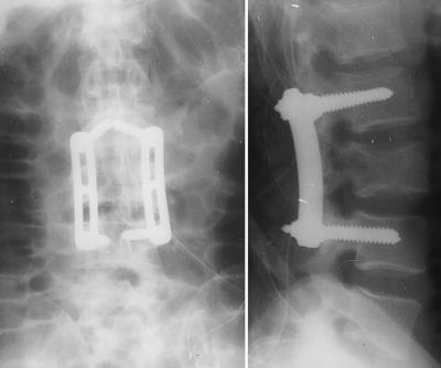 Steffe VSP (Implant 53)