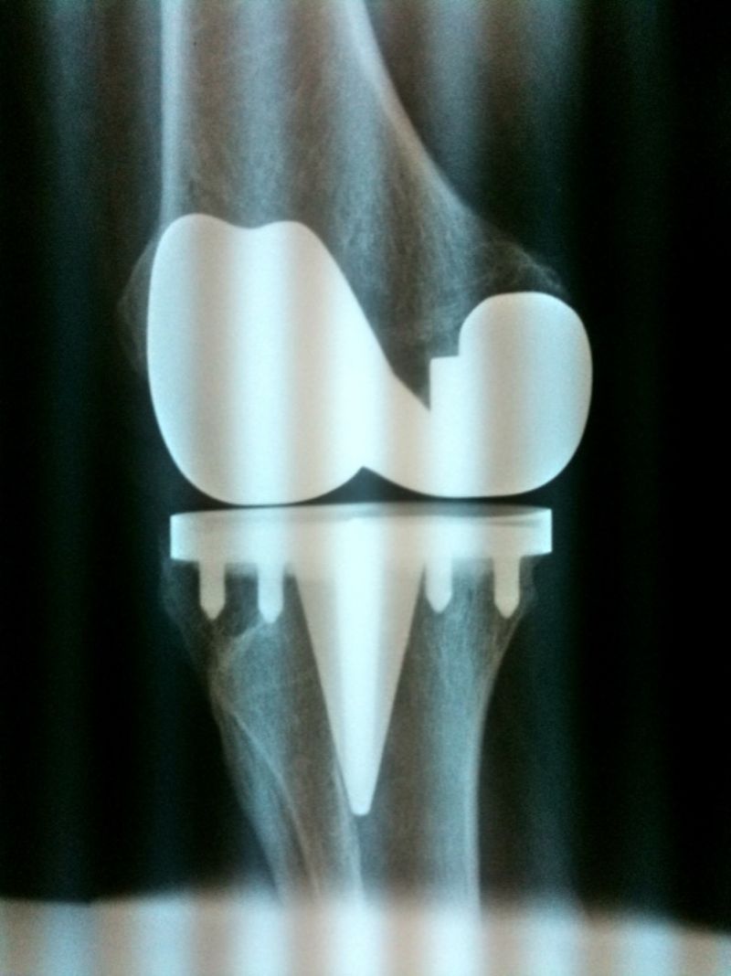 InterMedics Natural Knee II (Implant 4268)