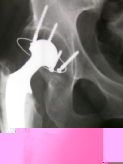 Morscher Isoelastic Cup (Implant 4031)