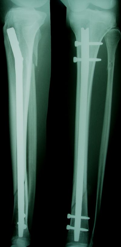 Tibia, Shaft:  Zimmer ZMS (Implant 61)