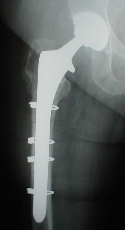 Smith & Nephew Echelon (Implant 3)