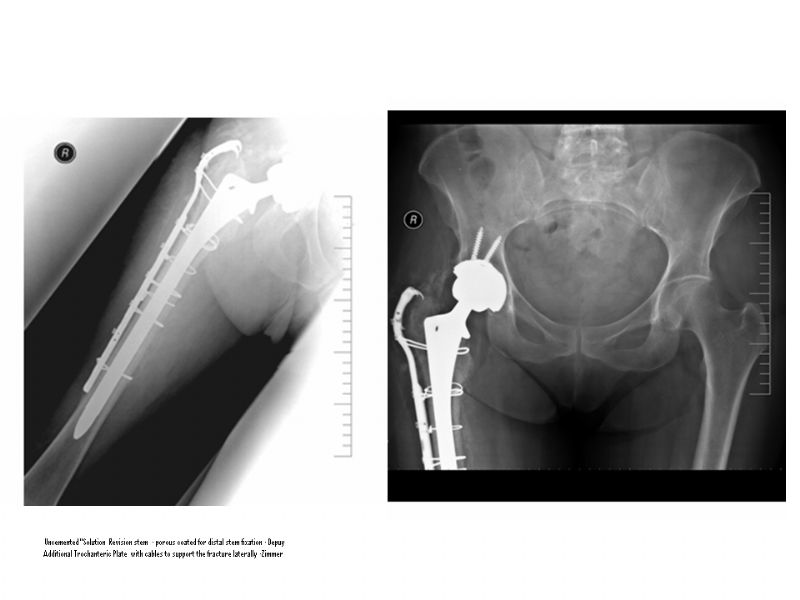 DePuy Solution (Implant 4270)