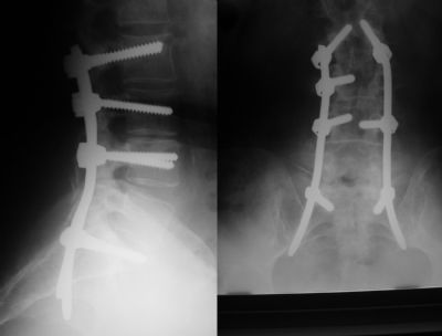 Interpore Synergy (Implant 388)