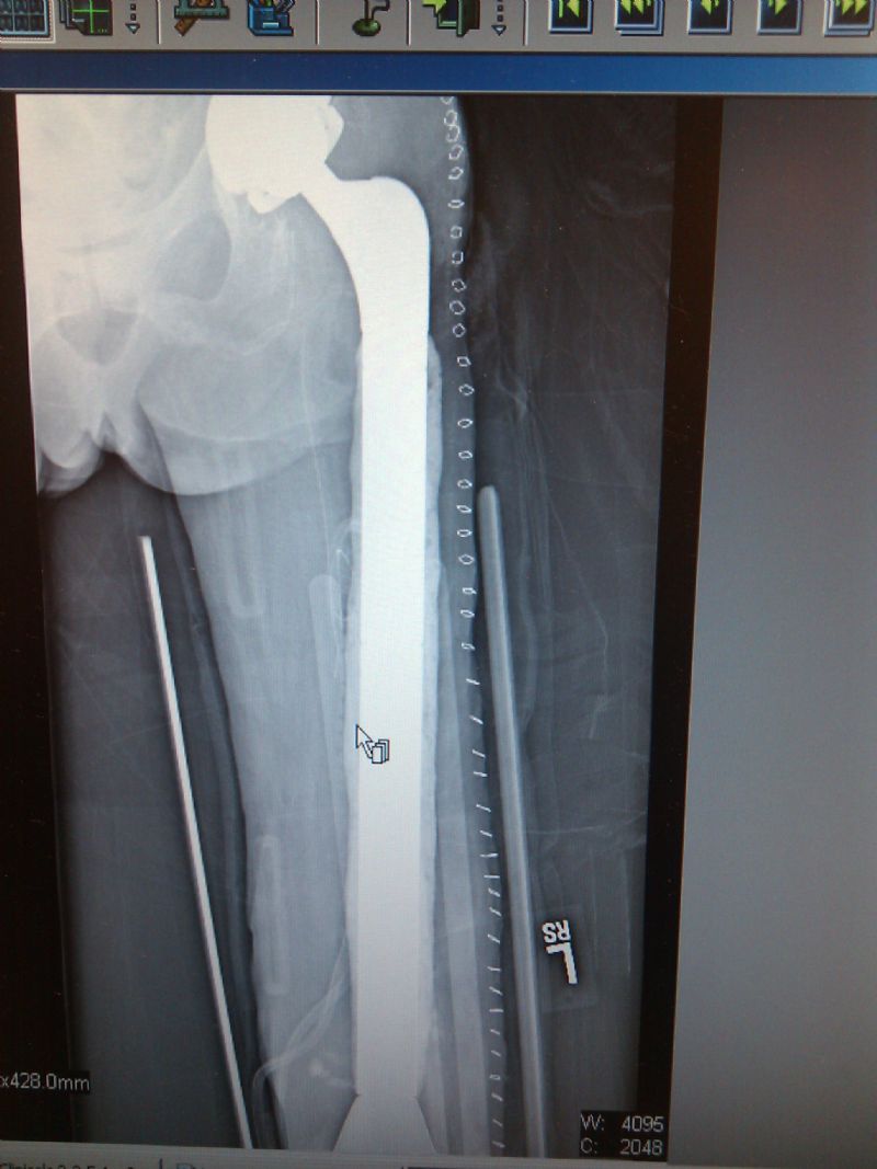 Pinnacle Cup with LPS Total Femur (Implant 4232)