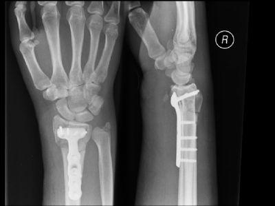 Radius, Distal:  Hand Innovations DVR Plate (Implant 66)