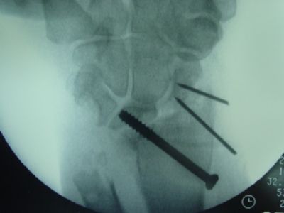 AO Cannulated Screw (Implant 191)
