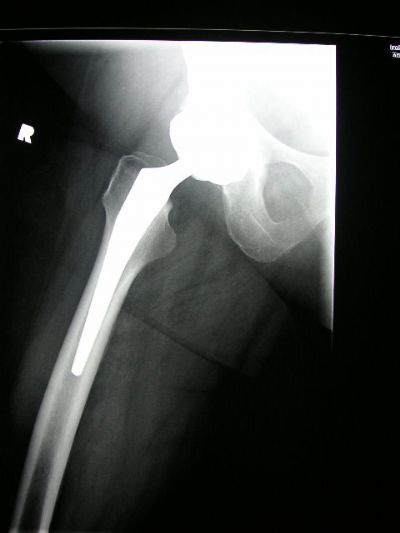 Accolade c surgical technique picture