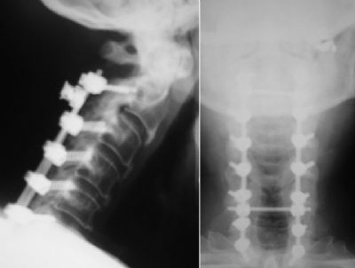 Spine, Cervical:  Medtronic Vertex (Implant 198)