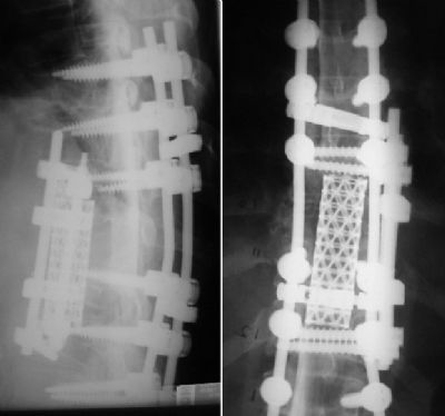 Spine, Thoracic:  Danek Pyramesh & Antares (Implant 200)
